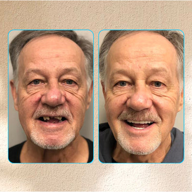 Adsorptive Dentures That Restore Your Bite And End Pain Fast - Image 9