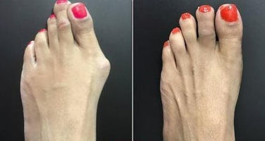 Orthopedic Toe Corrector For Hallux Valgus And Hammer Toes With Flexible Toe Spreader - Image 6